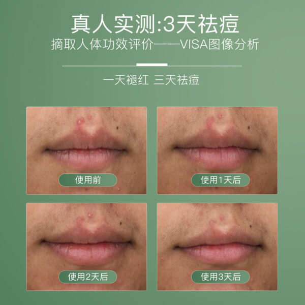 净痘清颜舒缓精华液