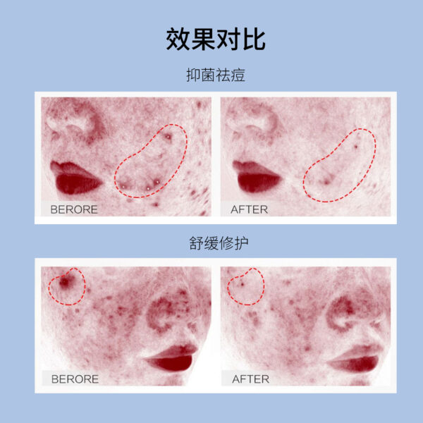 纳米钛净痘舒颜精华喷雾